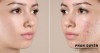 Đừng đổ lỗi cho nội tiết tố - Có những loại mụn do bạn đang tự gây ra!