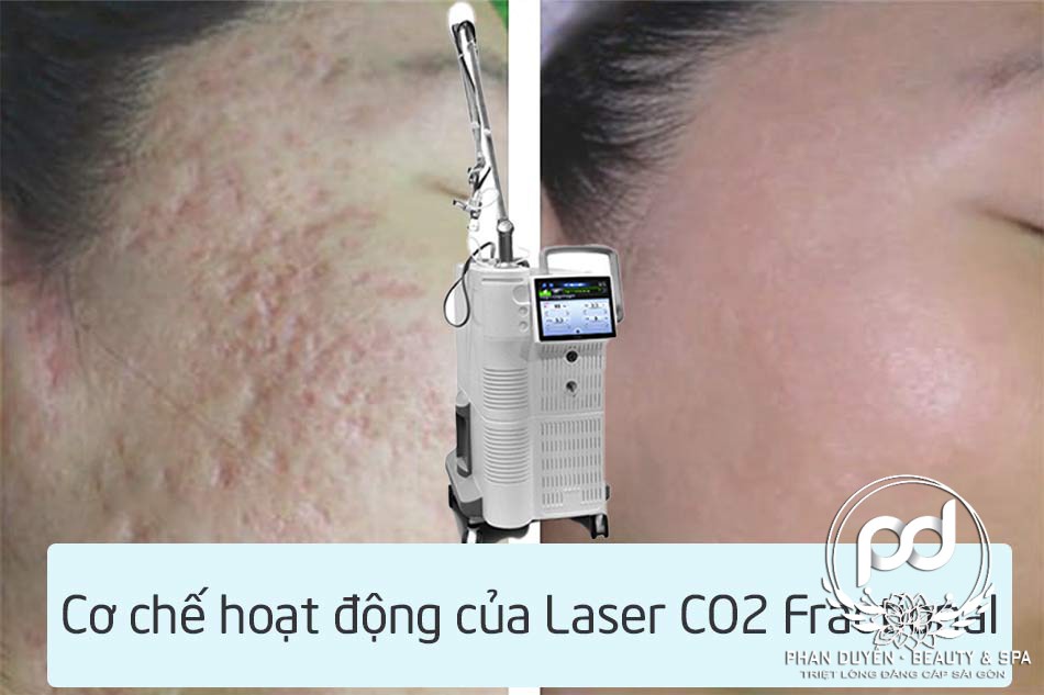 Công nghệ trị sẹo CO2 Fractional Laser là gì ?