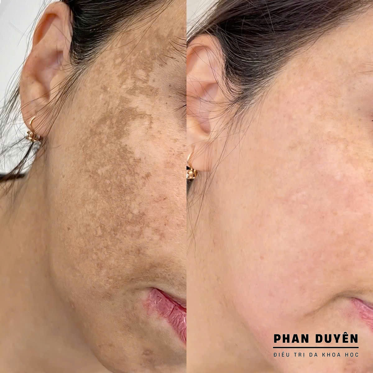 Điều trị da nám tại Phan Duyên Spa