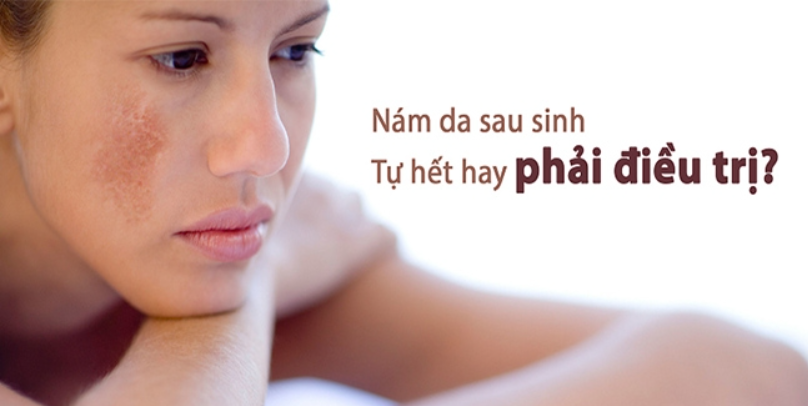 Nám da sau sinh