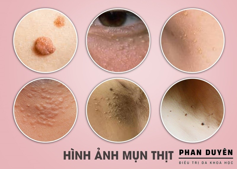 mun thit 1