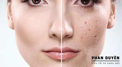 DA SẸO - ĐIỀU TRỊ DA SẸO RỔ